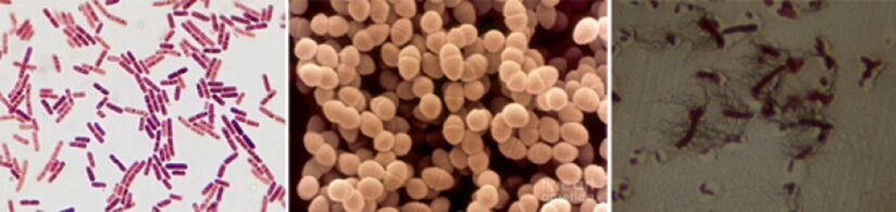 Escherichia -Sticks, Fäkalerokokken und Pro - die Hauptpathogene der chronischen bakteriellen Prostatitis