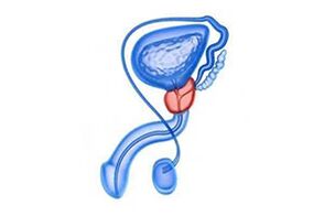Zeichnung einer Prostataentzündung