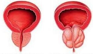 Gesunde Prostata und entzündet