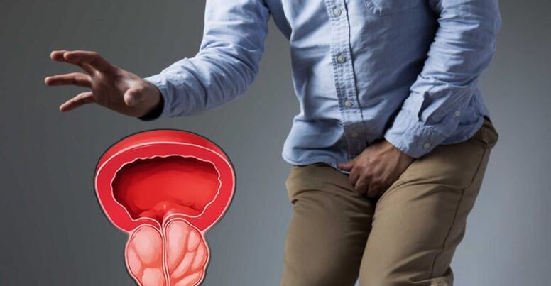 Prävention von Prostatitis und Prostata -Adenom